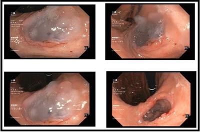 Pancreatico-gastric fistula arising from IPMN associated with ductal adenocarcinoma of the pancreas: a case report and a literature review